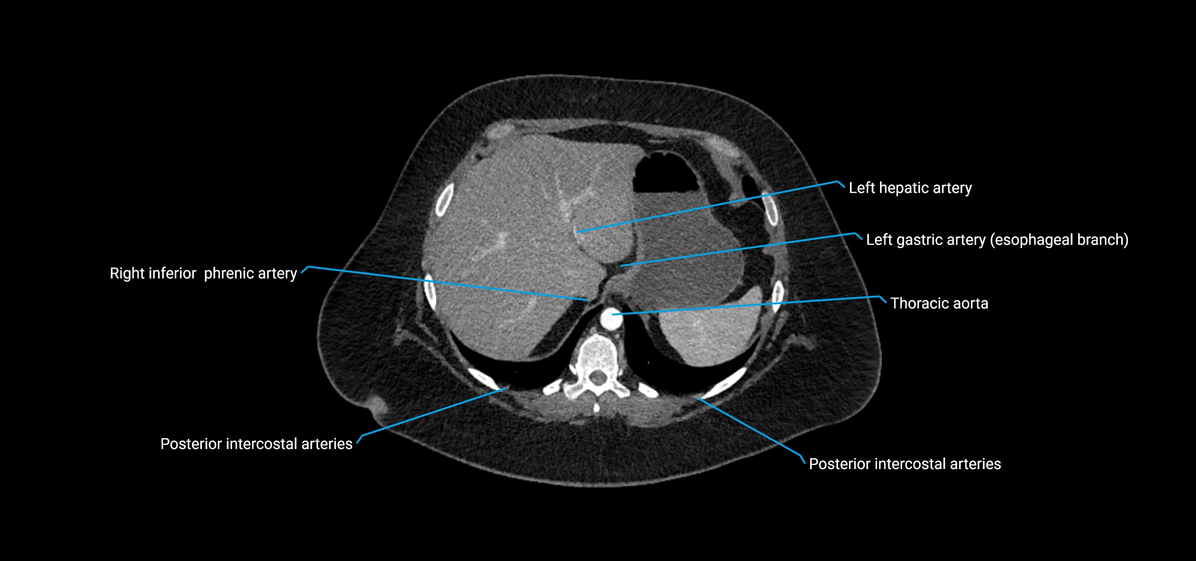 CTA abdomen axial cross sectional anatomy labelled image_31 (2).webp